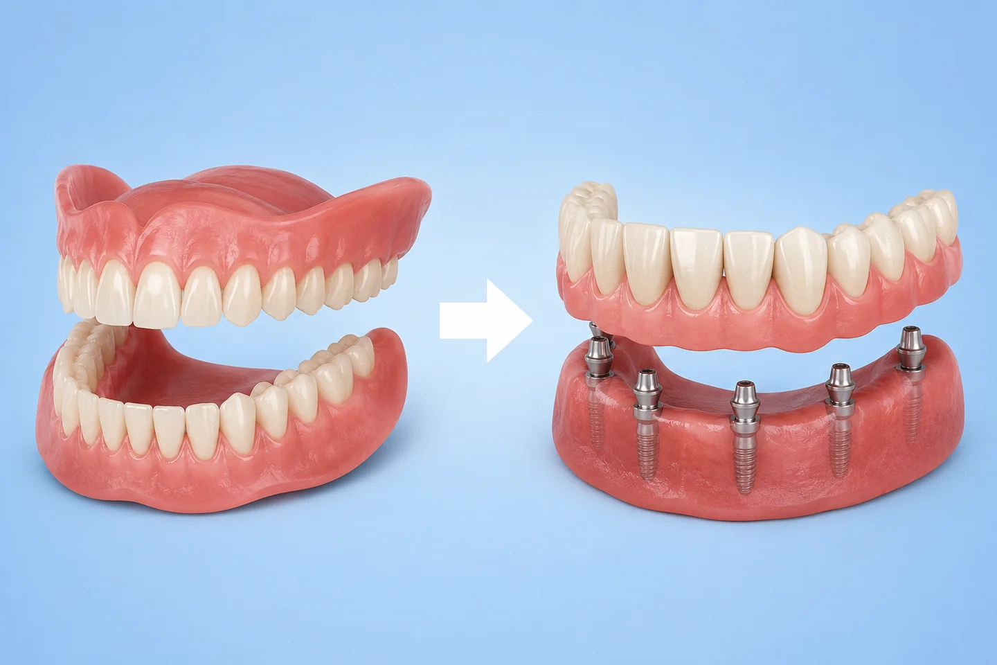 Replace Dentures With Dental Implants? Know When
