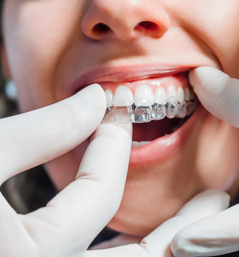 Where Can I Find the Most Affordable Invisalign?