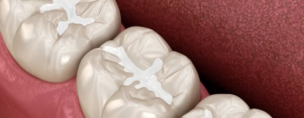 How Long Do Fillings Last?