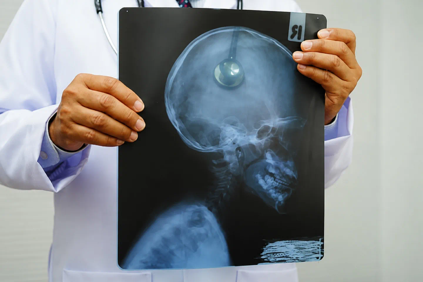X-Ray