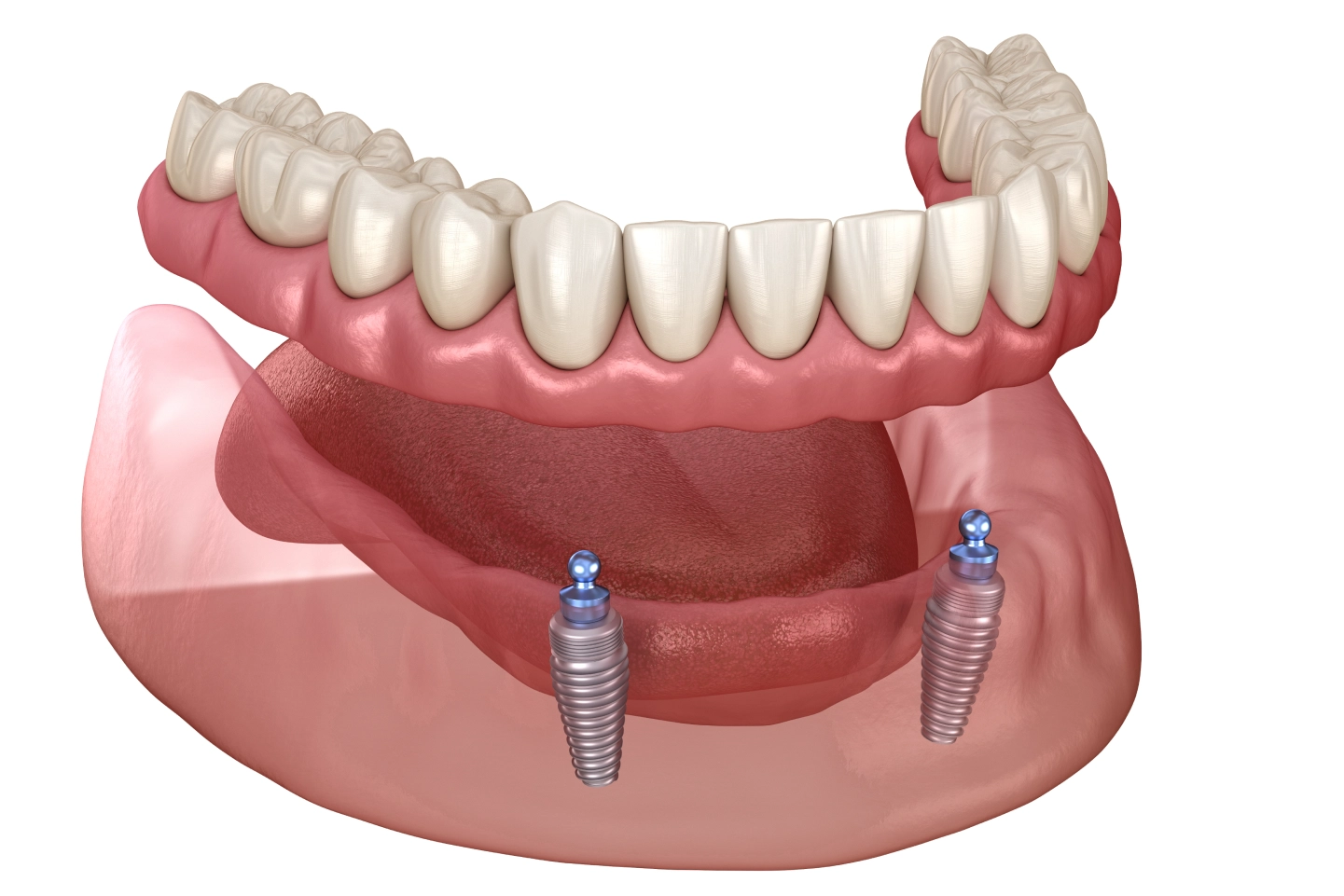 Implant Overdenture