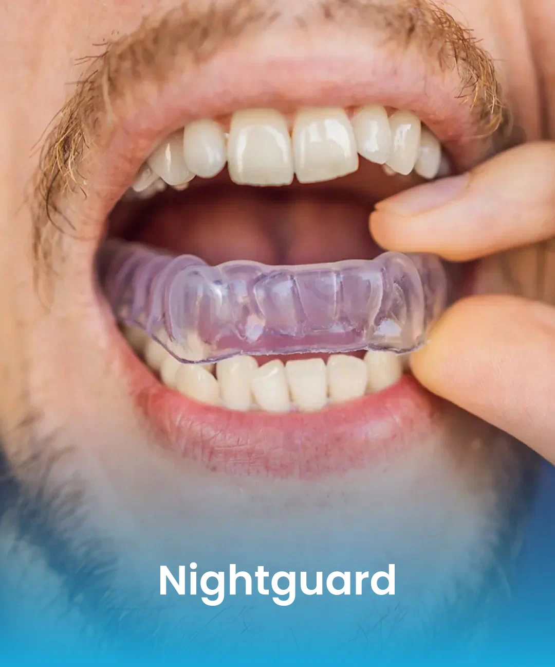 Custom dental nightguard for teeth protection