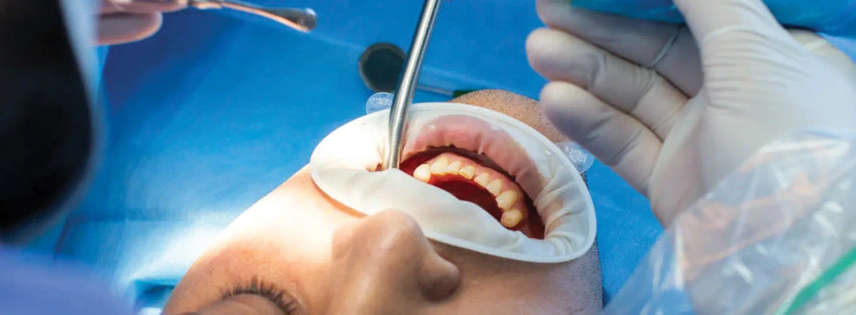 Surgical Tooth Extractions | Expert Surgical Dentistry