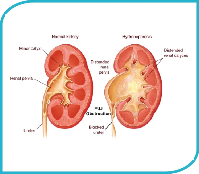 Laparoscopic Pyeloplasty