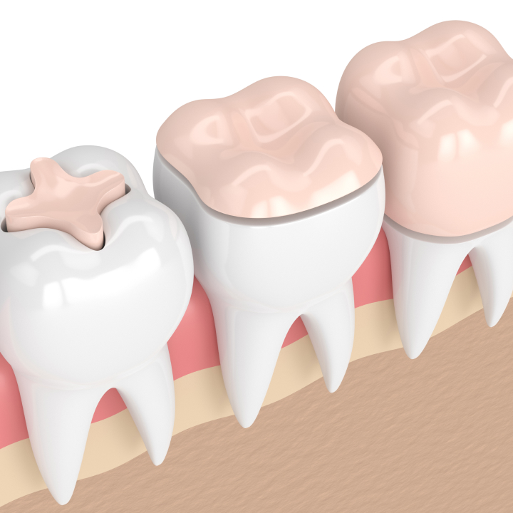 Dental Fillings in Irvington, NY