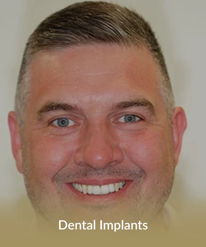 Dental Implants Card