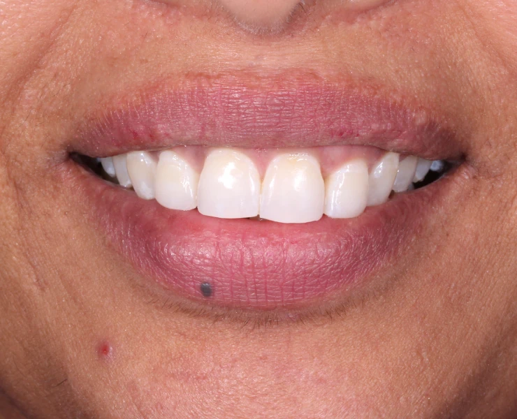 After Invisalign