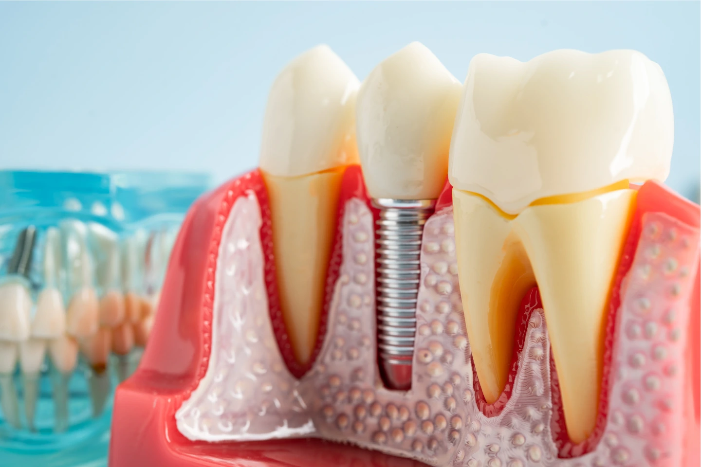 Dental Implants vs Dentures vs Bridges | Tooth Replacement