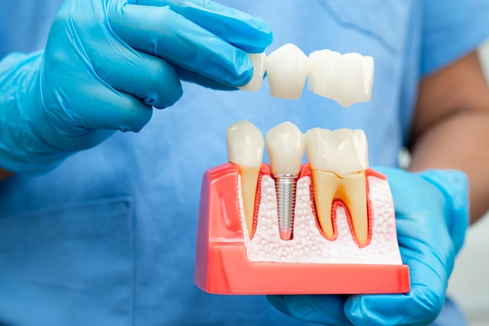 All-on-4 Dental Implants