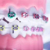 How Long Does The Inman Aligner Take To Work?