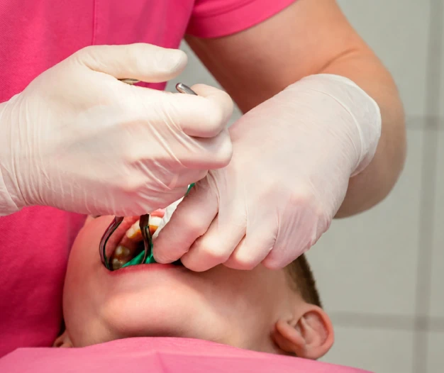 Pulpotomies (Baby root canal)