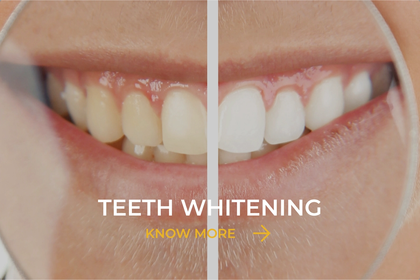 Teeth Whitening