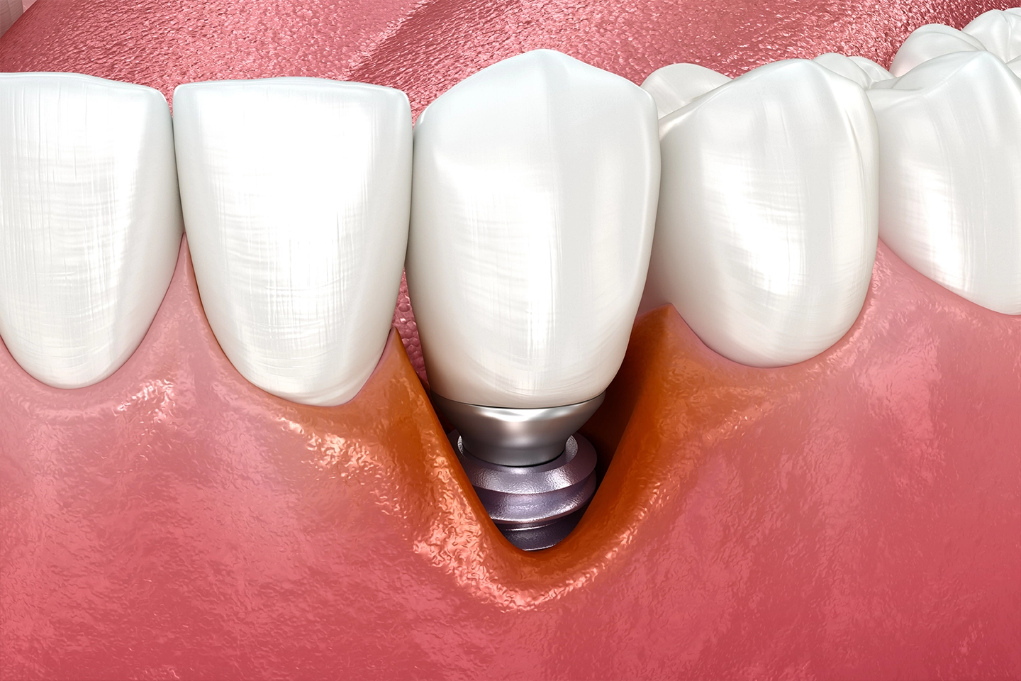 The Dental Implant Procedure Great Smile Dental, Marietta GA