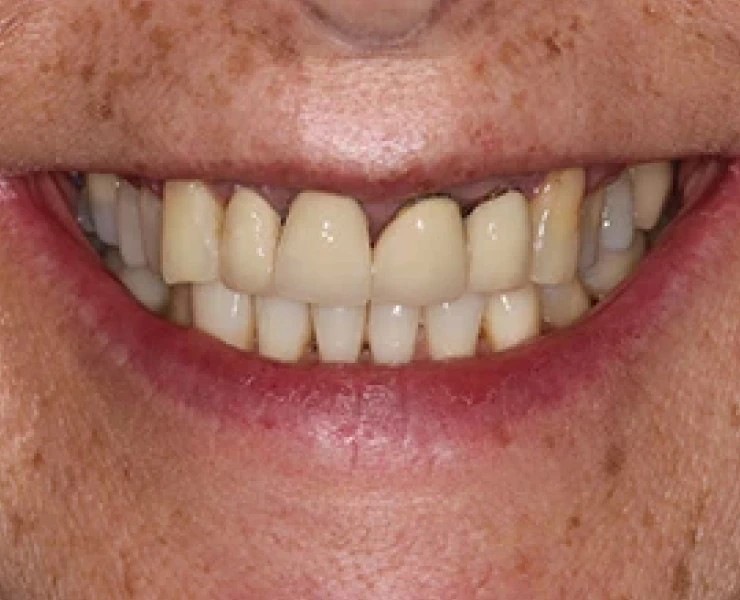 Porcelain