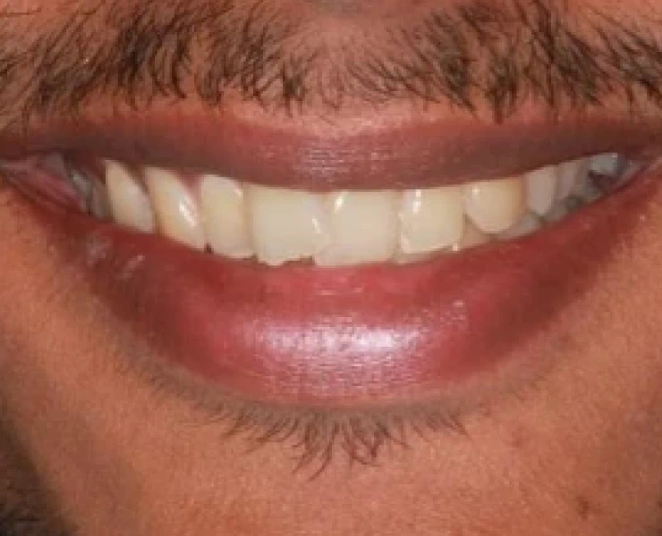 Invisalign Case 3