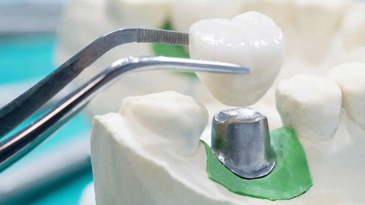 Dental Crowns