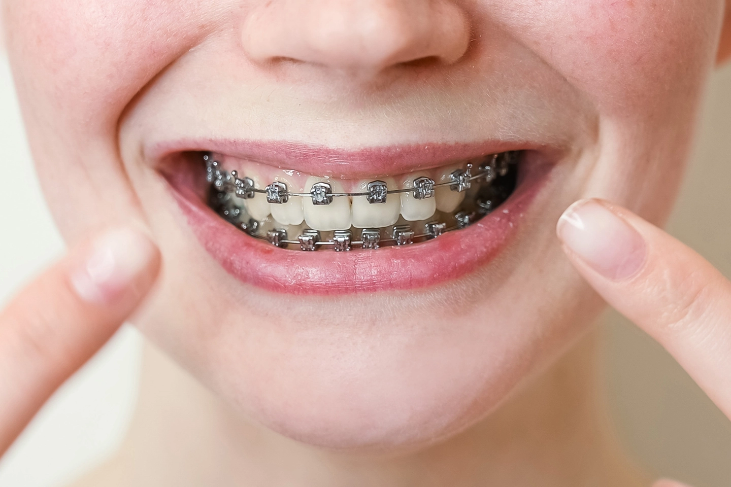 Dental Braces: Indications, Complications And Restrictions