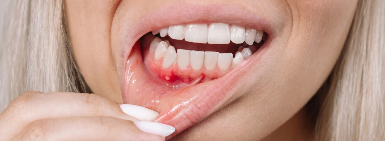 Gum Treatment