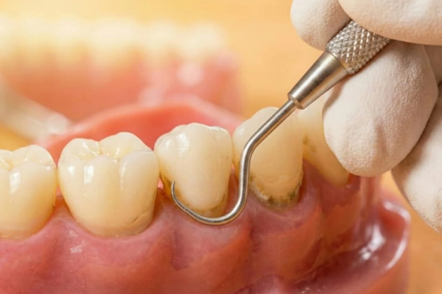 Root Canal Treatment Illustration