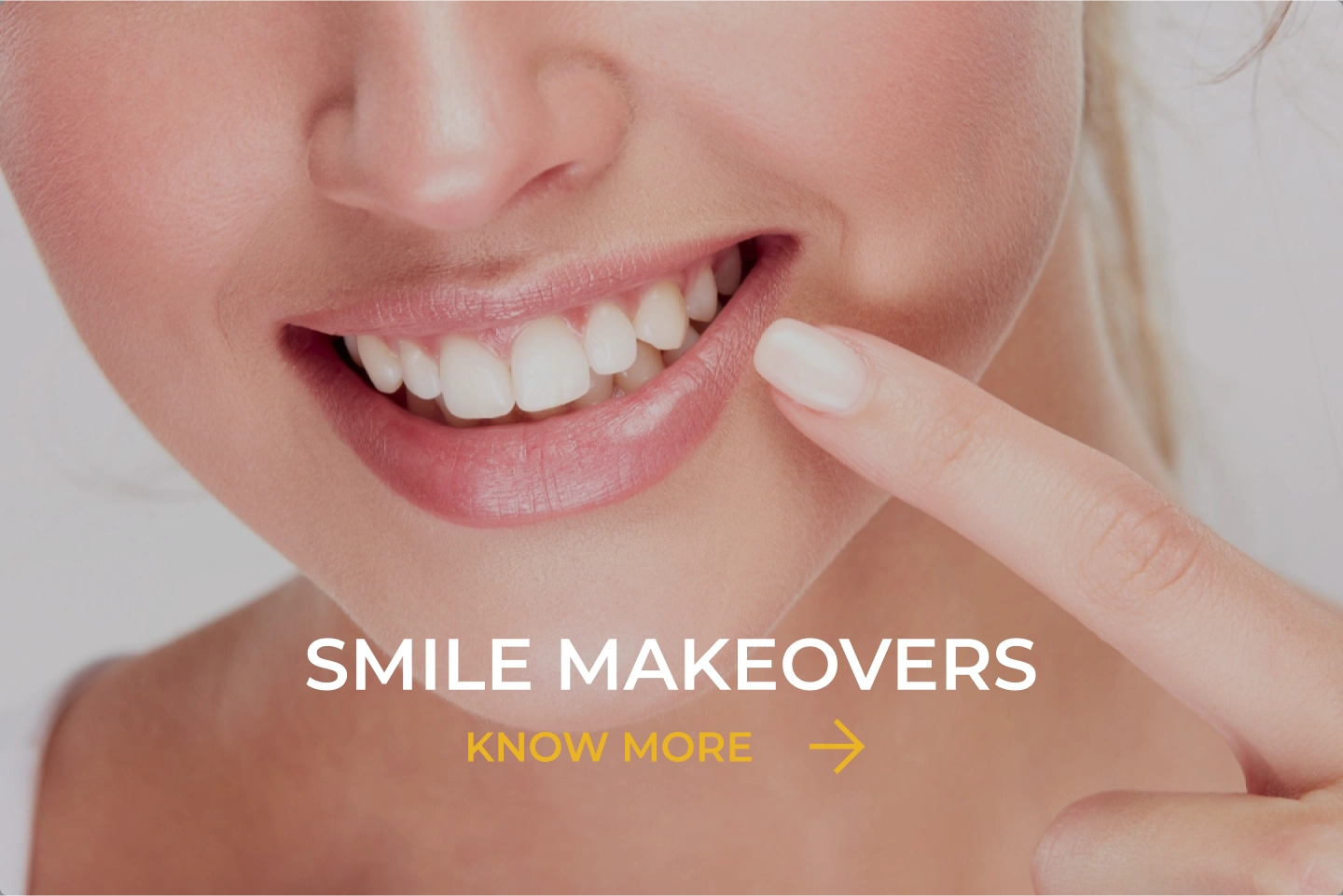 Smile Makeover image