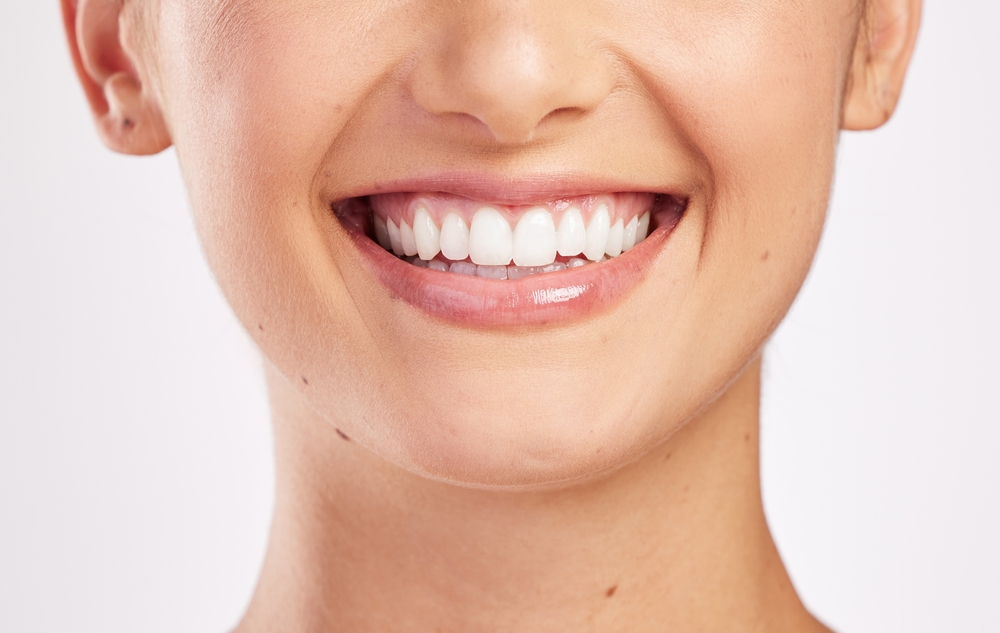 Veneers