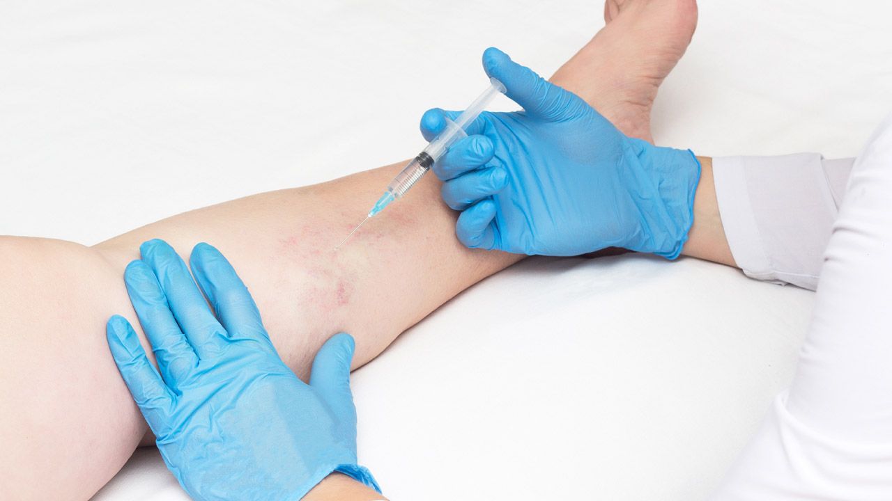 Laser Vein Treatment