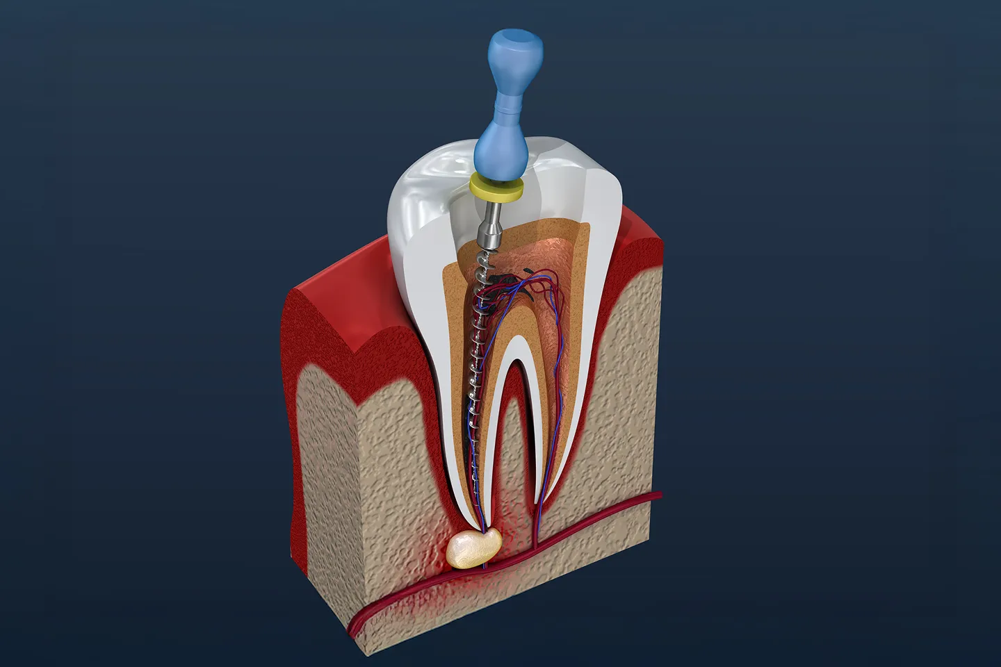 Root Canal Treatment