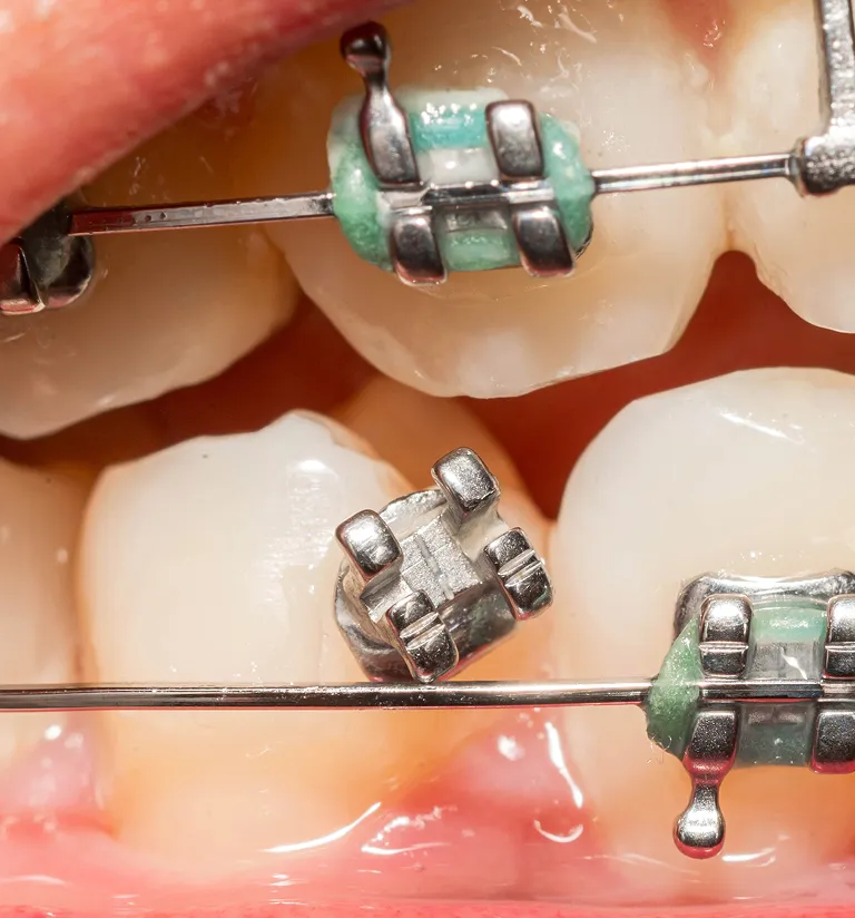 Dentist taking care of emergency pain of a patient with dental braces