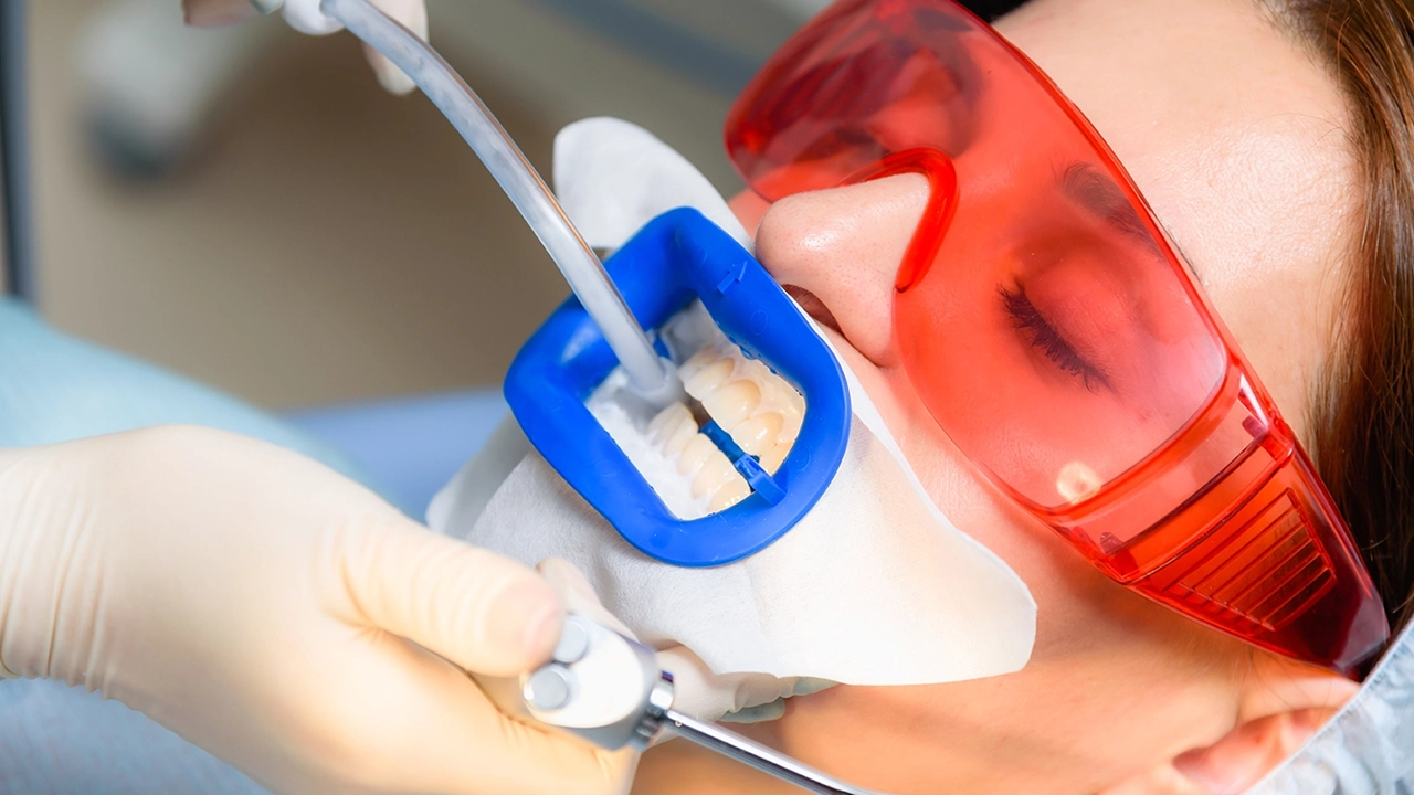 Teeth Whitening at Dentist Great Smile Dental, Marietta GA