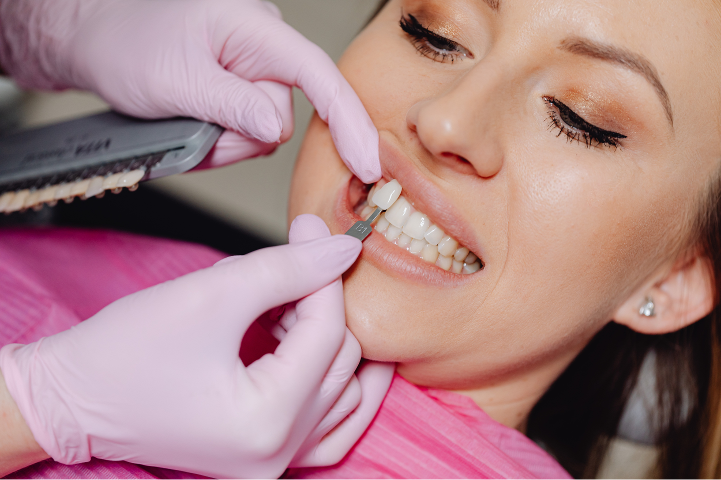 The Benefits of Dental Crowns and Veneers