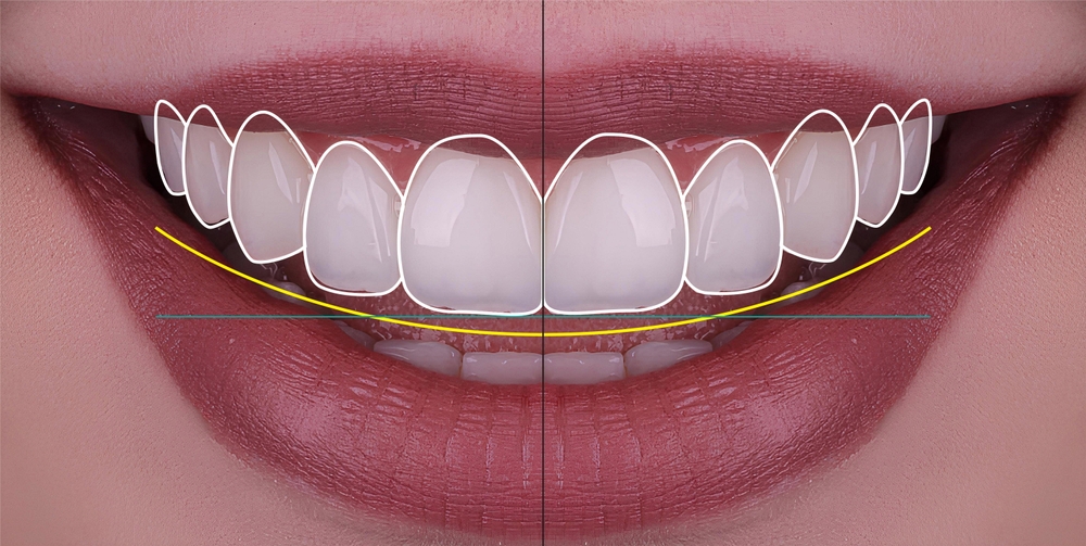 Digital Smile Design