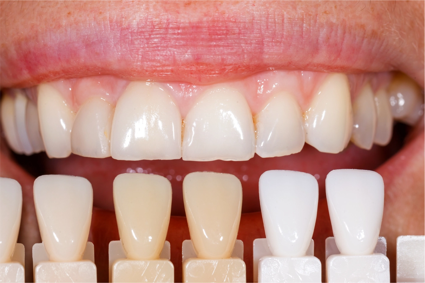 Porcelain Veneers