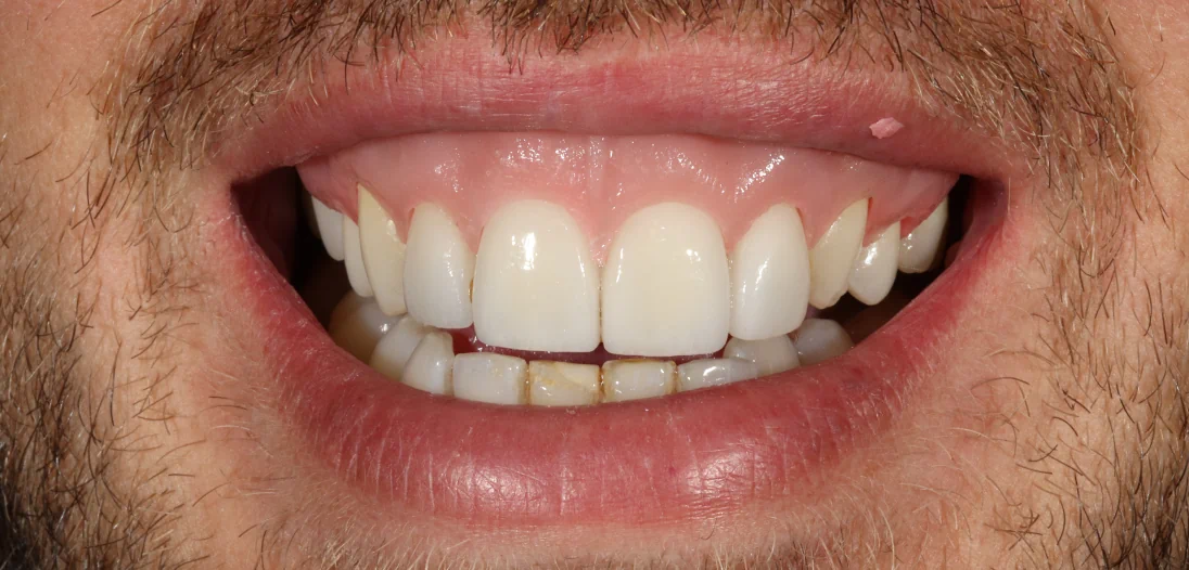 Porcelain Veneers