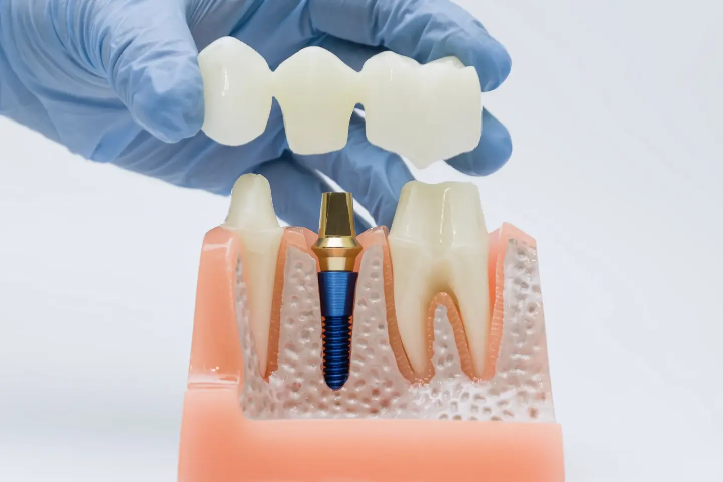 Signs You Need a Dental Crown