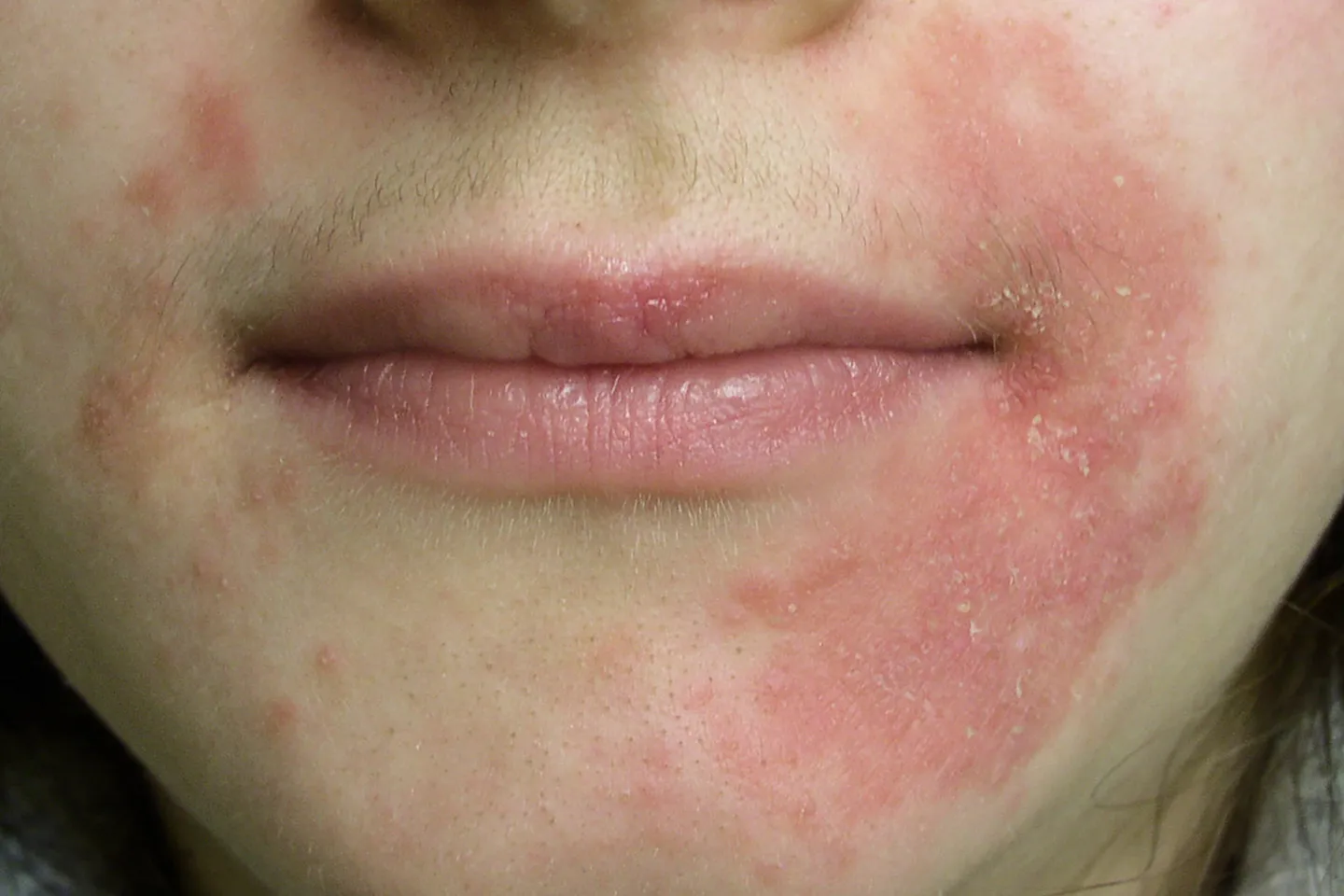 Perioral dermatitis is a red rash that circles the mouth