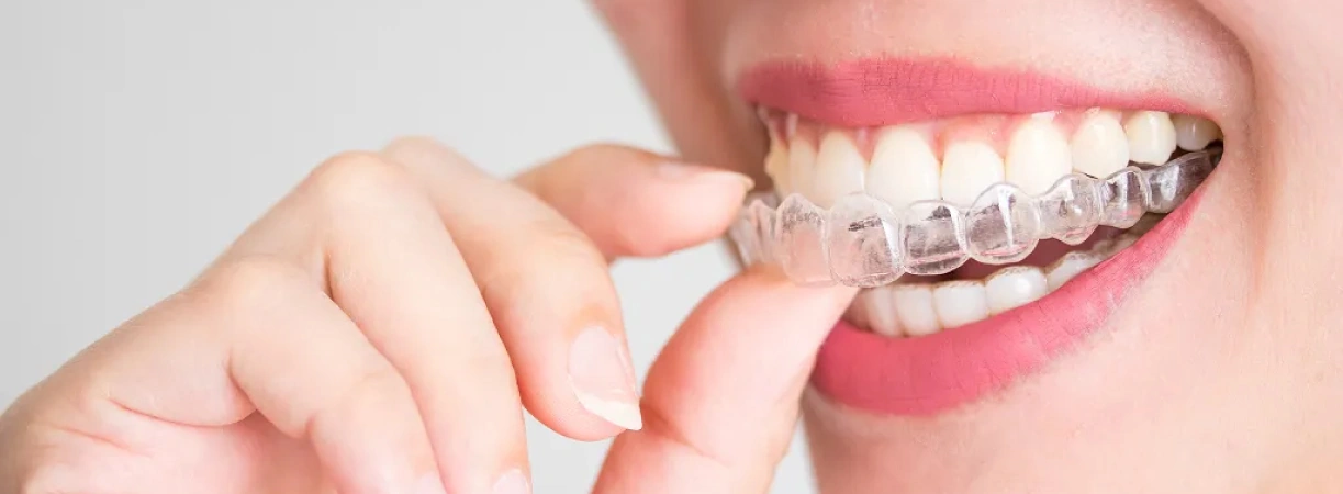 Clear Braces