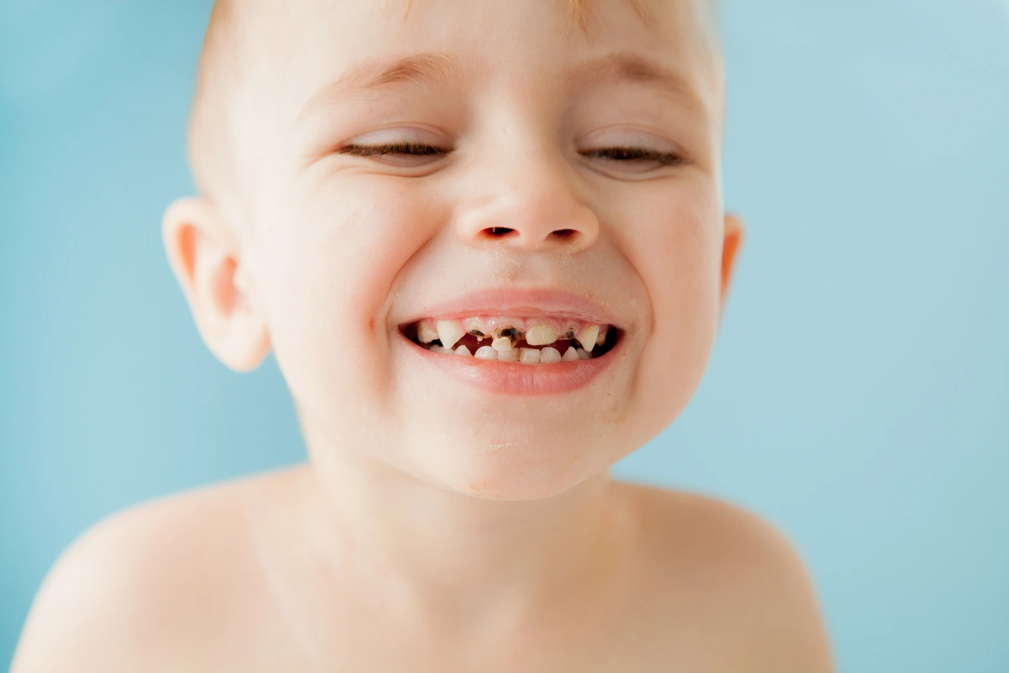 Early Childhood Caries Treatment in Chapin, SC | Parent Guide