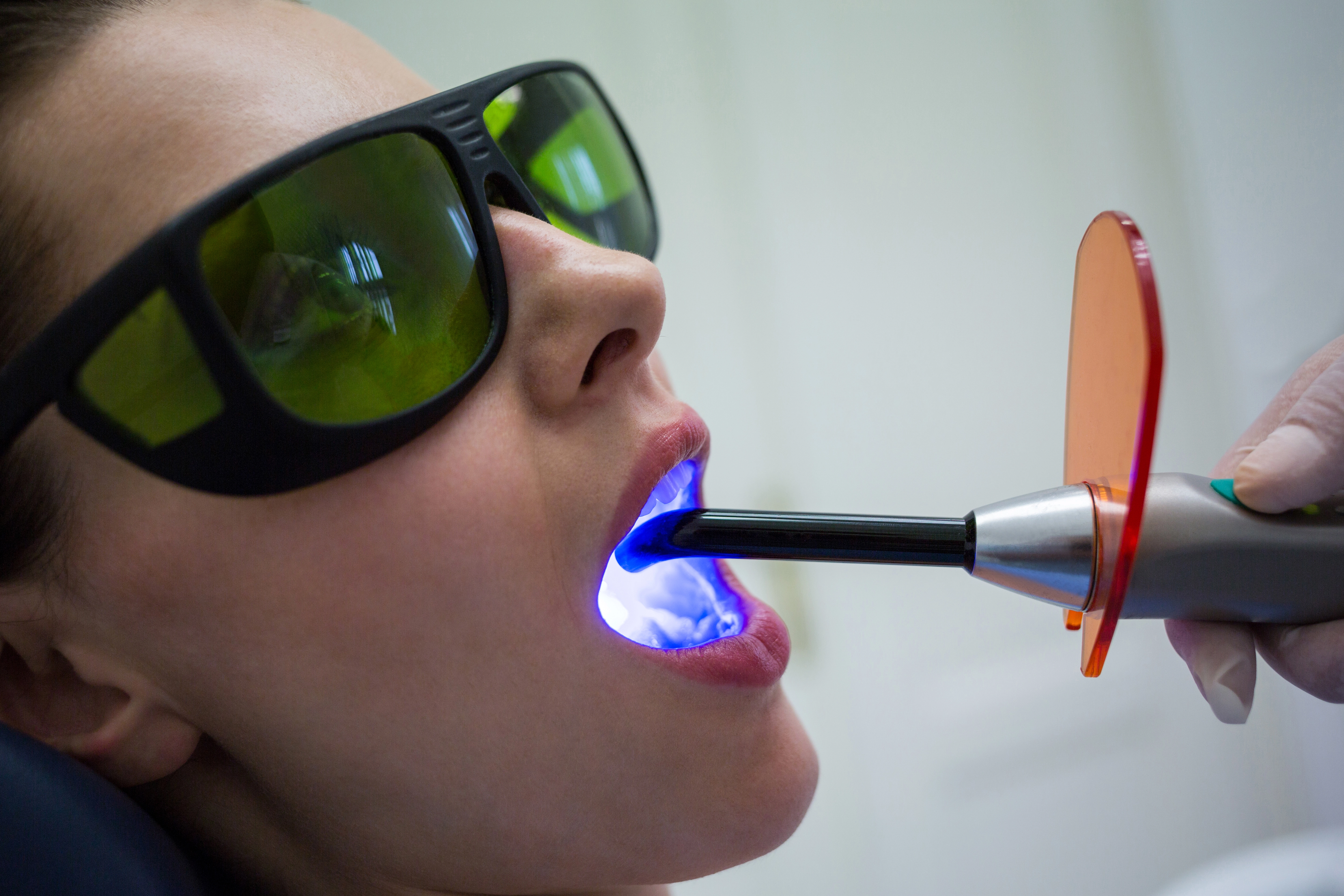 Sealants & Fluoride