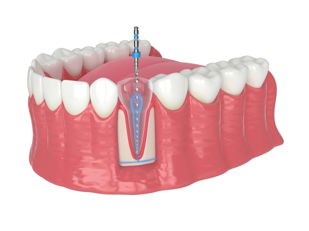 Root Canal