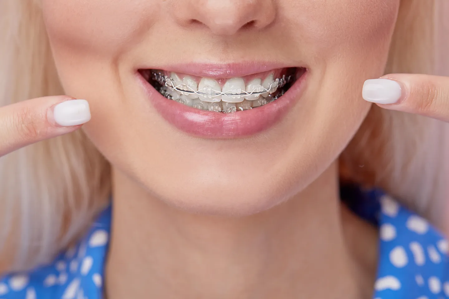Why Do Different Braces Cost Different Amounts
