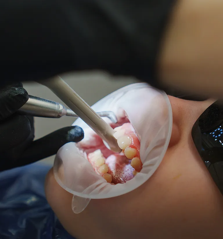 Why See Royal Dental Care For Dental Implants?