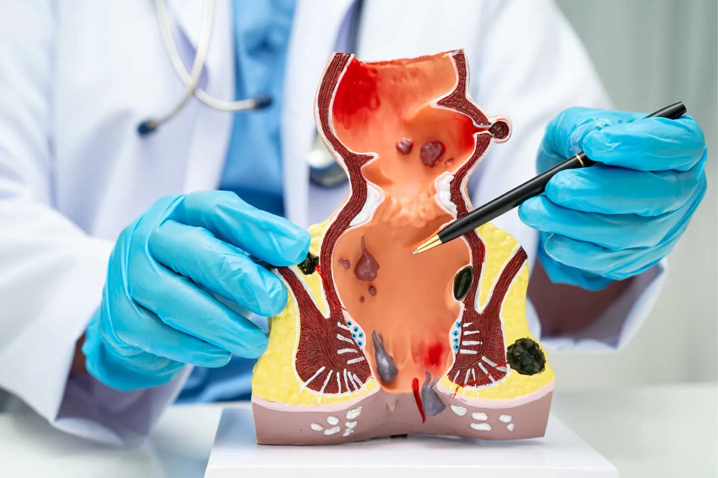 Perianal Diseases/ Proctology