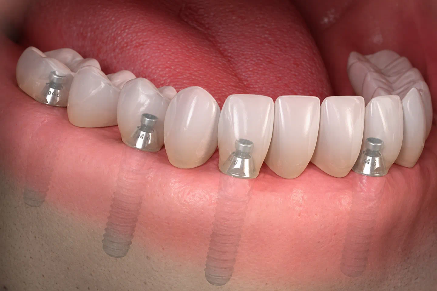 Dental Implants