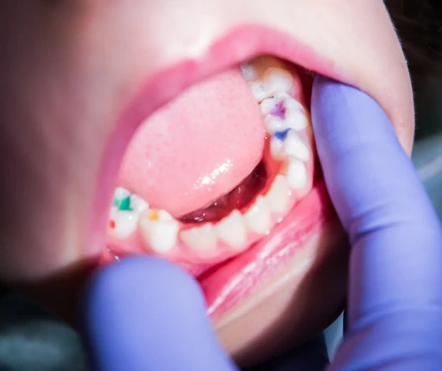 Sealants
