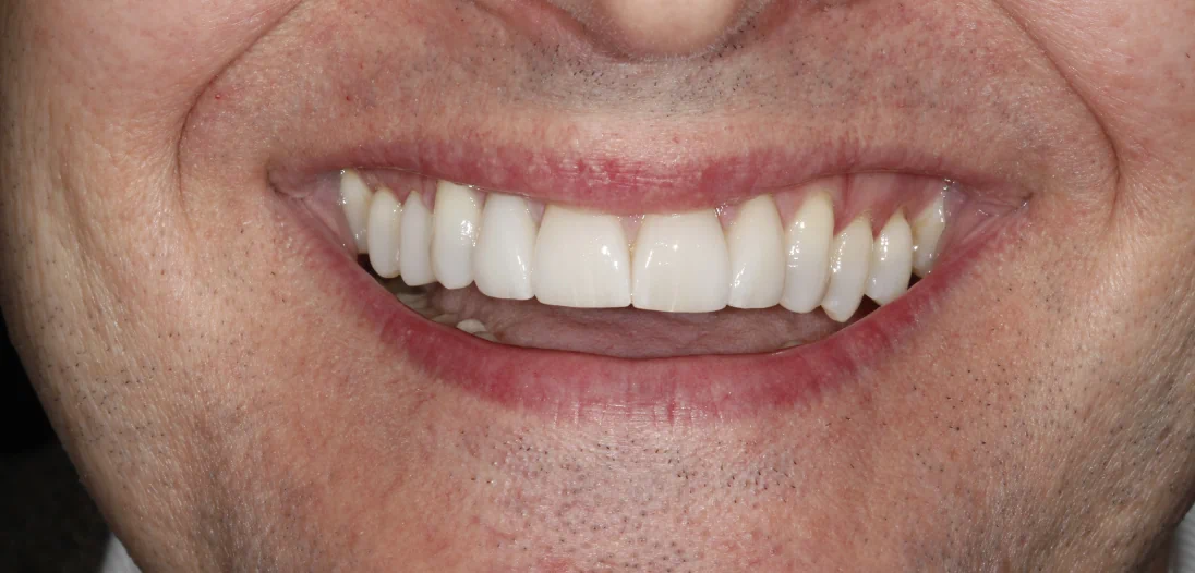 Smile Makeovers