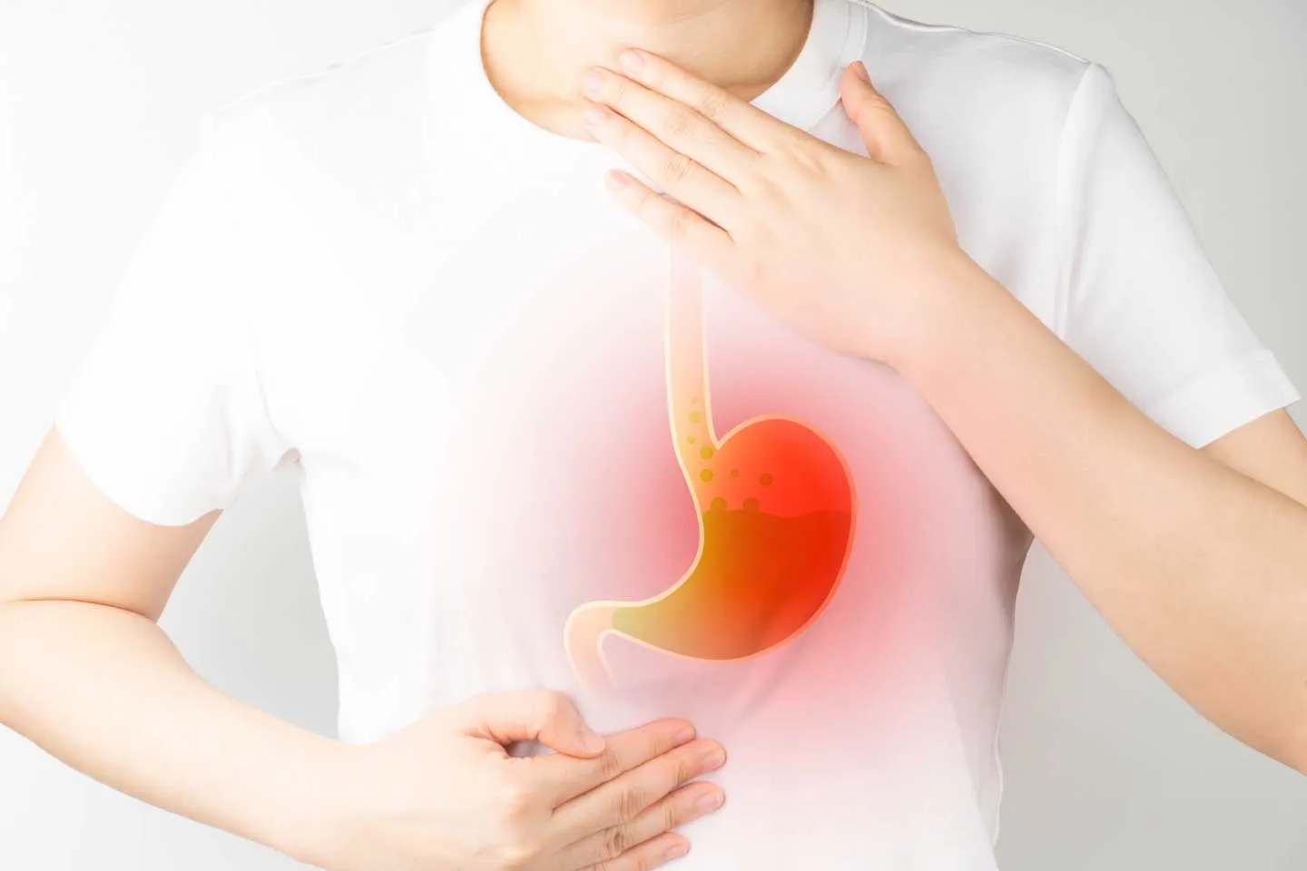 Gastroesophageal Reflux Disease (GERD)
