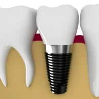 How Much Does a Full Arch Dental Implant Cost In UK?