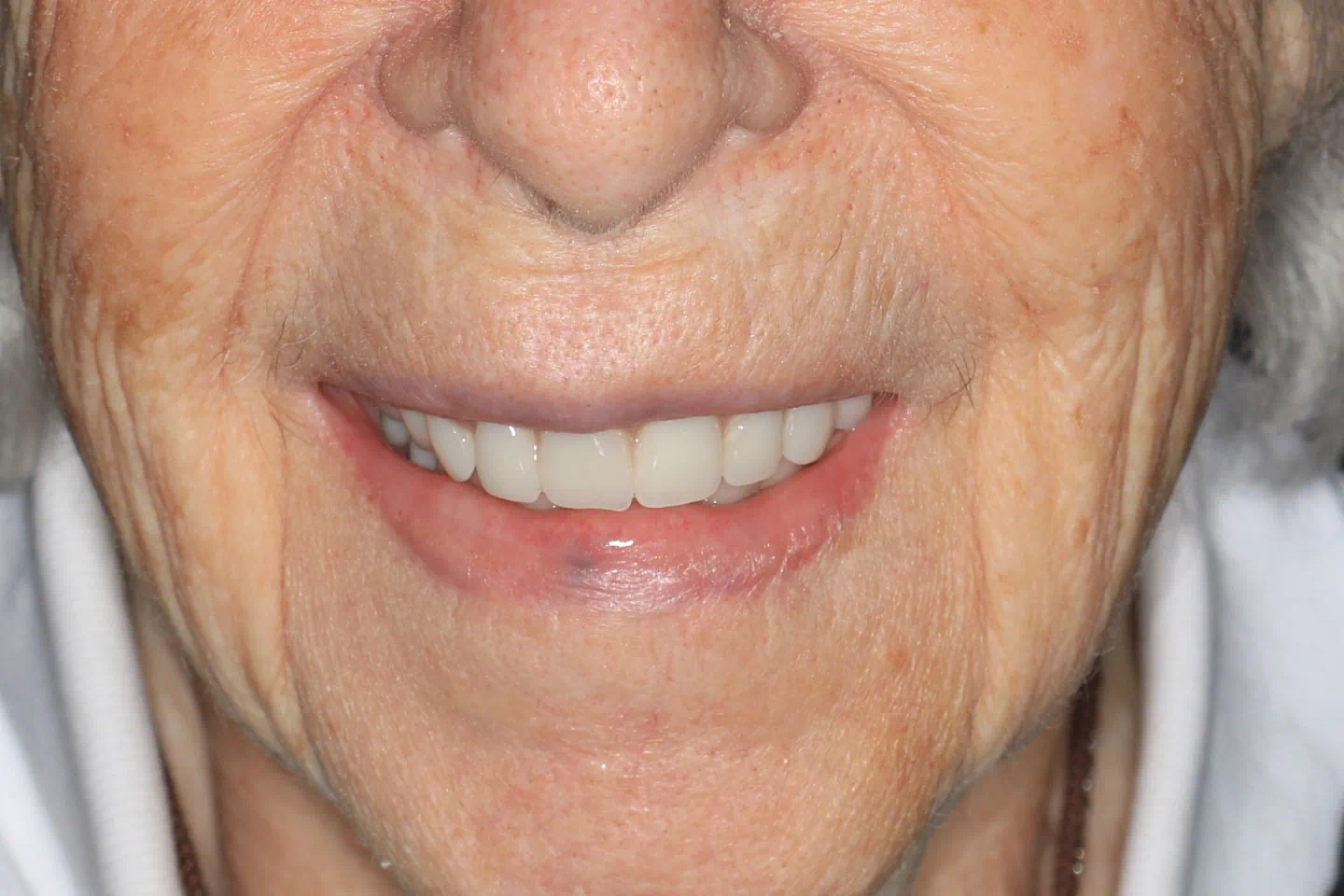 After denture treatment