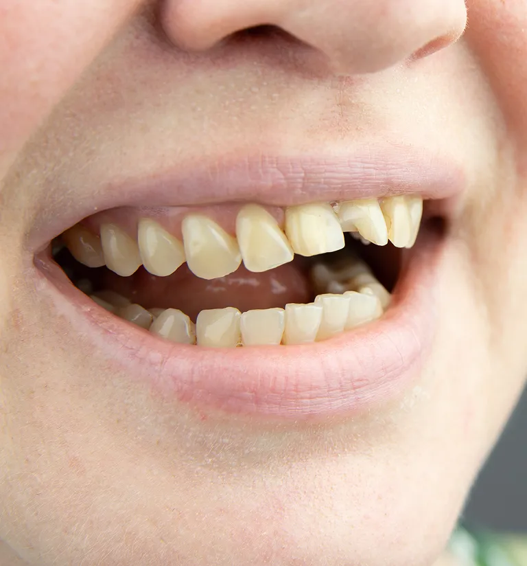 diagram of a chipped tooh