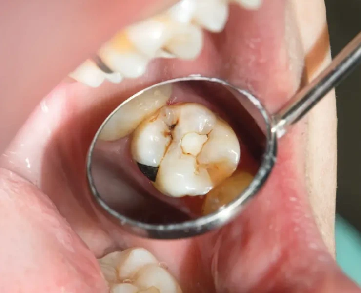 Composite Fillings Before Image